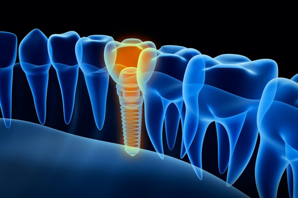 DENTAL IMPLANTS in WILLIAMSBURG VA offer many benefits to patients with missing teeth
