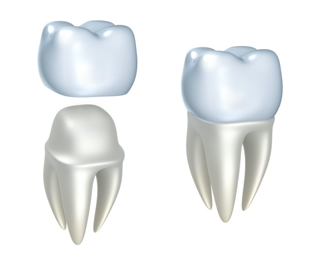 DENTAL CROWNS in WILLIAMSBURG VA are often the last option before an extraction