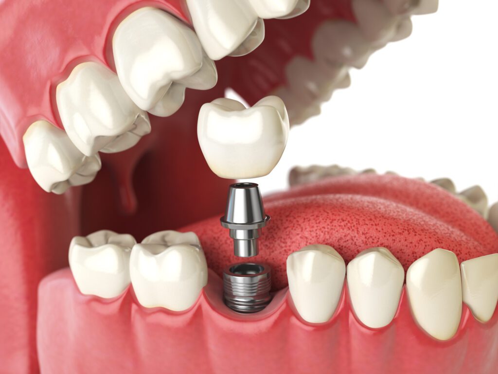 Dental Implants Williamsburg, VA