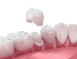 Why Dental Crowns Are Important to Oral Health in Williamsburg, VA
