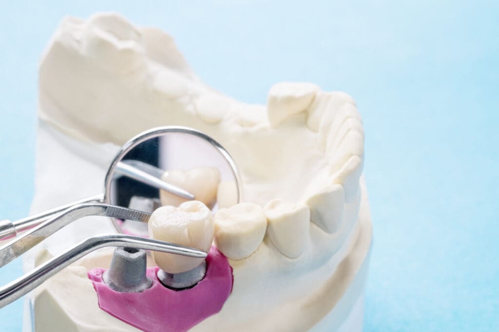 The Dental Implant Process in Williamsburg VA