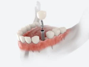Dental Implants vs. Bridges: Which Is for You? in Williamsburg, VA