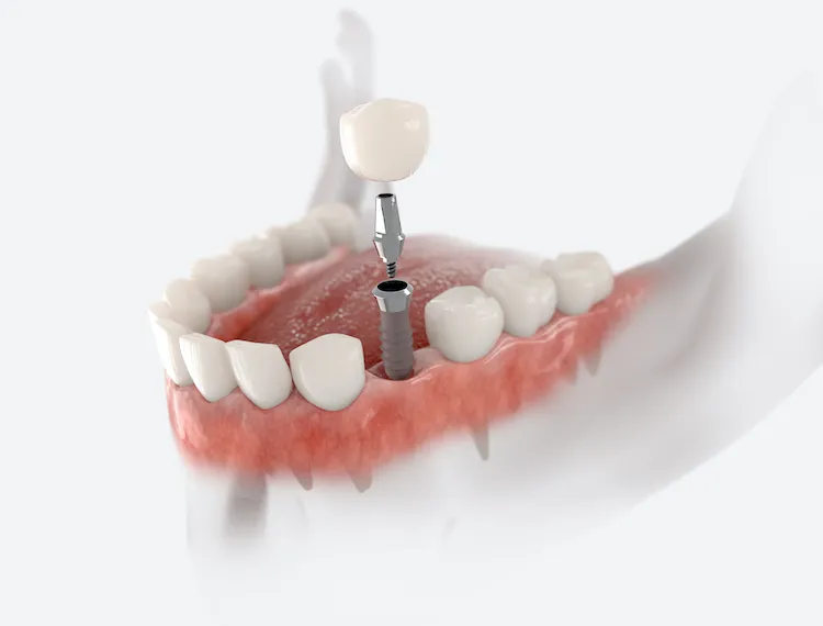 Dental Implants vs. Bridges: Which Is for You? in Williamsburg, VA