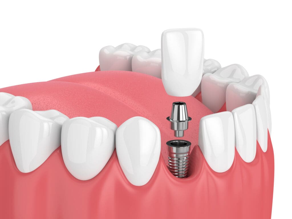 Single Dental Implant in Williamsburg VA