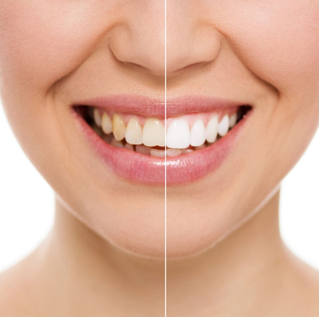 Teeth Whitening in Williamsburg VA